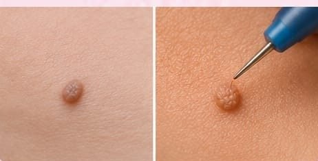 Warts Removal